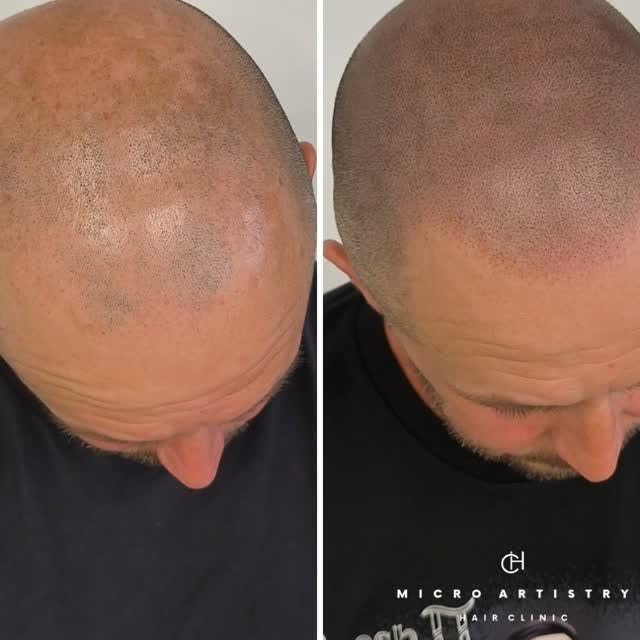 Fresh off the needle 🪡 

4th session SMP hairline restoration results.

Age appropriate & natural �