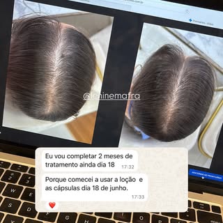 Menos de 2 meses de tratamento e um detalhe que chama atenção: a linha de partição está menos eviden