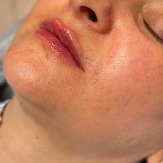 Dudak Dolgusu 👄💋

📌 Profil İçeriği Bilgilendirme Amaçlıdır, Tanı, Tedavi ve Detaylı Bilgi İçin Mu