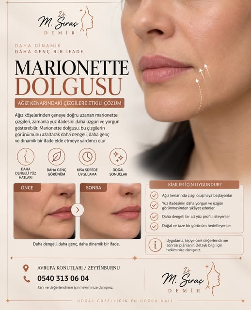 ✨ Ağız kenarındaki çizgiler yüz ifadenizi olduğundan daha yorgun gösterebilir.

Marionette çizgileri