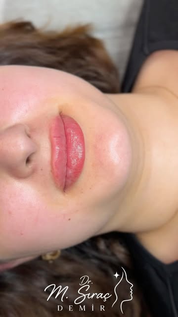 💋 Dudak Dolgusu Uygulaması

Dudak dolgusu; dudakların hacim, kontur ve simetri açısından değerlendi