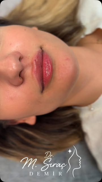 💋 Dudak Dolgusu Uygulaması

Dudak dolgusu; dudakların hacim, kontur ve simetri açısından değerlendi