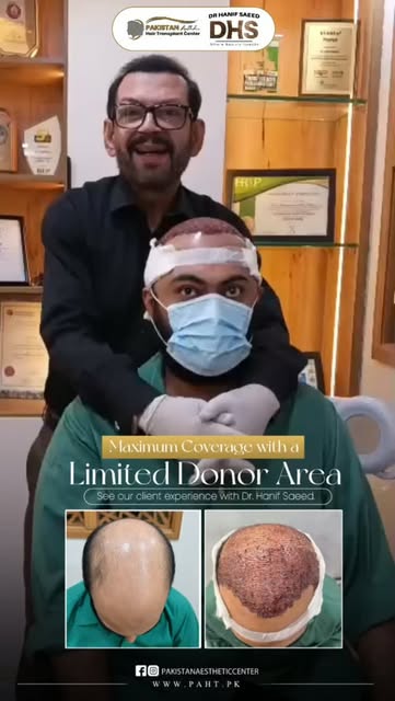 Maximum Coverage With Limited Donor Area 

#hairtransplant #karachi #skincare #skincare #skincare