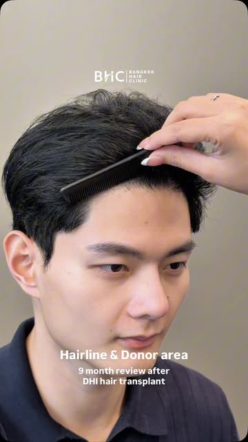 9 month follow up with our superstar patient @jien.piyapat. The hairs are still improving after the 