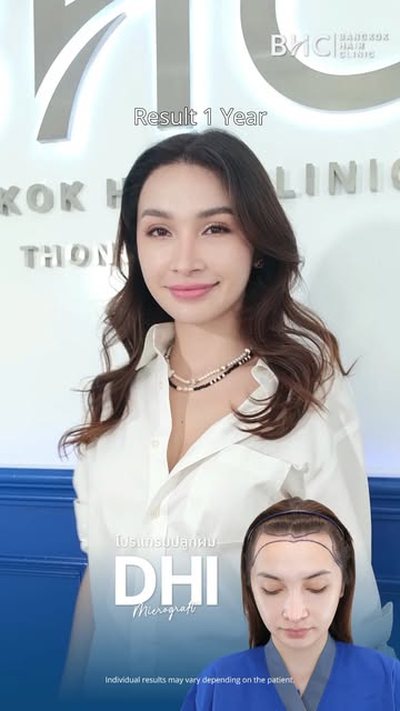 DHI Micrograft | 1-Year Result �A fuller appearance, a natural-looking hairline, and one year of vis