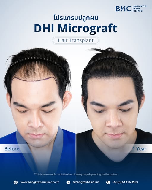 One year after a DHI Micrograft hair transplant, this transformation highlights the impact of a pers