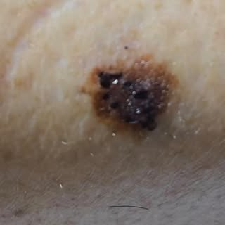 Observar os sinais da pele é extremamente importante, pois reconhecer e tratar precocemente um cânce