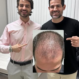Esse é o Alan, sua transformação é inspiradora! 

Antes do transplante capilar, ele enfrentava desaf
