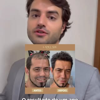 Um ano depois: o resultado do transplante do Hênio fala por si.

Hênio tinha uma calvície grau 4 na 