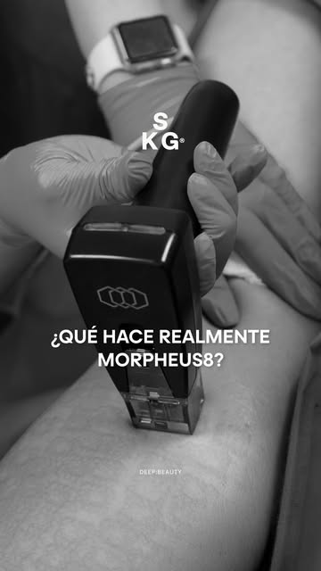¿Por qué cada vez más personas hablan de Morpheus8?

En este reel, el Dr. te explica cómo funciona e