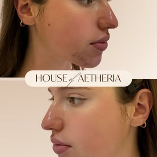Came to India with acne.
Leaving with clear, confident skin from House of Aetheria.

#HouseOfAetheri