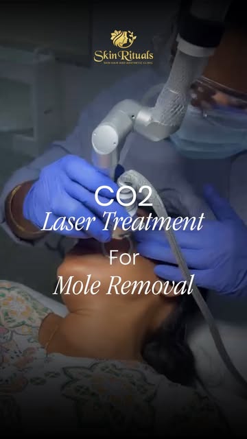 Mole removal doesn't have to mean a scalpel and stitches. 

Our CO2 laser treatment removes moles an