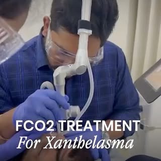 Those soft yellow patches around your eyes have a name — xanthelasma — and they're harmless choleste