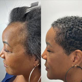 5 months after hair transplant to correct Traction Alopecia , and you can already see the progress. 