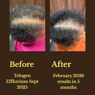 Stop making this HUGE mistake. Waiting.... thinking your hair loss will get better. Honestly, it mig