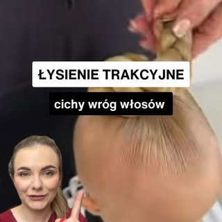 Łysienie trakcyjne to wypadanie włosów od ciasnych fryzur. Przewlekłe napięcie skóry głowy powoduje 