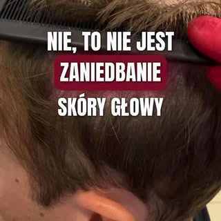 Sucha łuska nie zawsze oznacza łupież. Dlatego przypadkowo wybrany szampon przeciwłupieżowy nie zaws