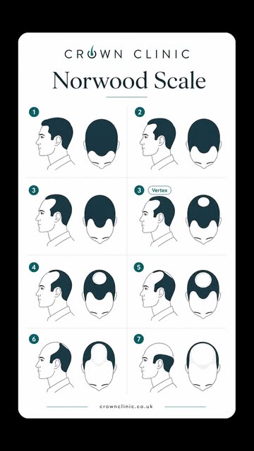 Not all hair loss looks the same. Here's how Dr. Shahmalak classifies male and female hair loss befo