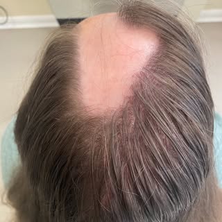 Hair loss comes in all kinds of ways, a consultation with me will discover the underlying cause and 