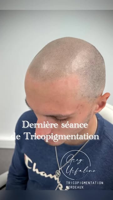 Malgré un test de Tricopigmentation peut concluant dû à une dermite,  nous avons quand même décidé d