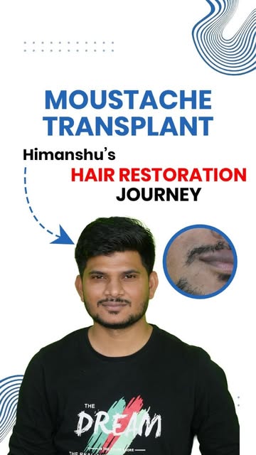 A Fuller Moustache. A More Defined Look.

Moustache Transplant at Regain Roots - designed for a natu