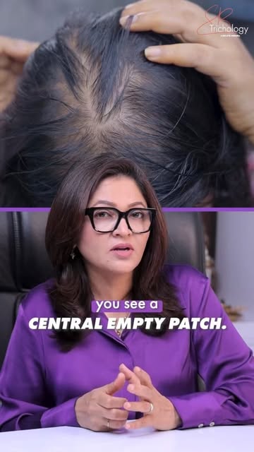 A sudden bald patch on your scalp is not something to ignore. ⚠️

A clearly defined patch of hair lo