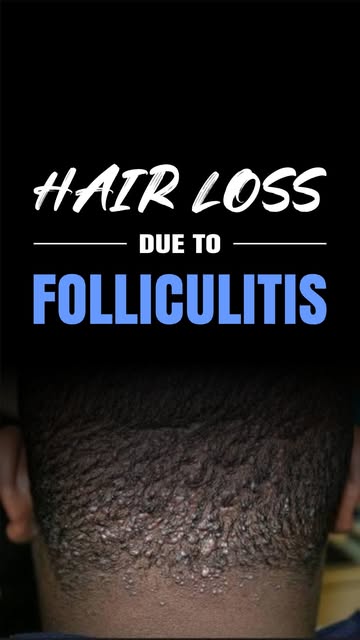 What is the longterm management of folliculitis? 

Let’s watch the short clip for insight!

#hairhub
