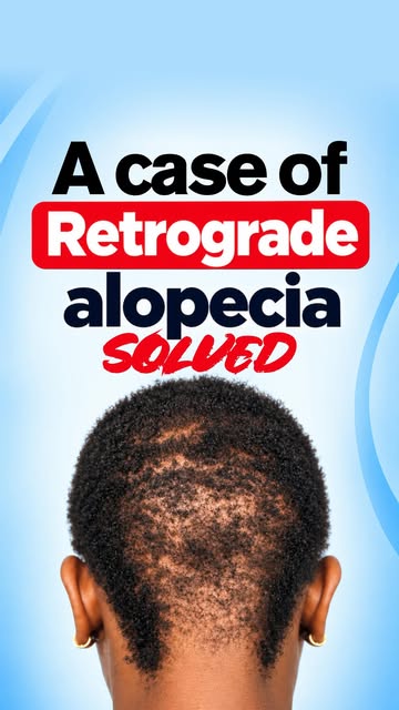 Struggling with thinning on the sides or back of your head? It might be Retrograde Alopecia.

Here i