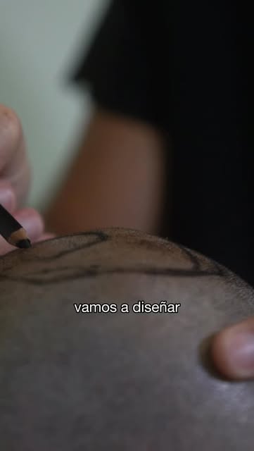 Un implante capilar comienza mucho antes de la cirugía.
Desde la planificación y el diseño personali