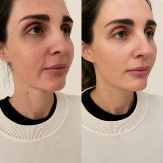Naturally lifted, rejuvenated, and refreshed.

No surgery and same day result.

This is the Dr. G Li