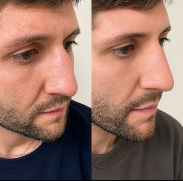 Rhinoplasty without surgery?

This is my Non-Surgical Rhinoplasty.

Little to no downtime.

This cas