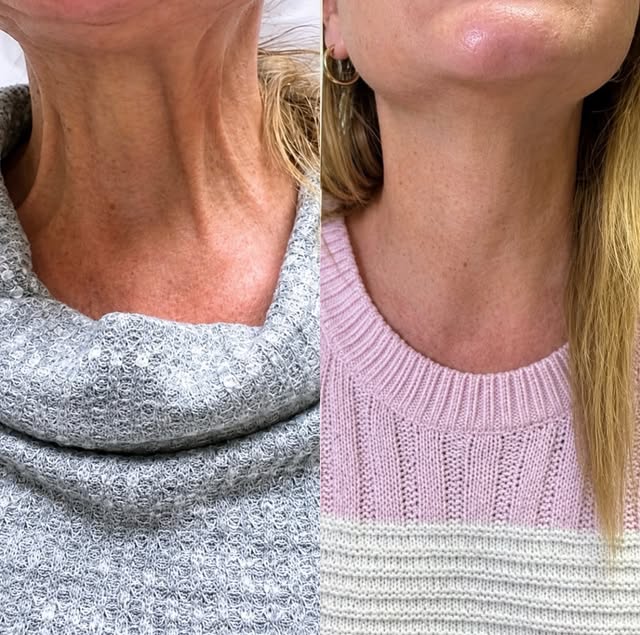 No surgery. Little to No Downtime. Too good to be true?

This is my Non-Surgical Neck Lift.

The nec