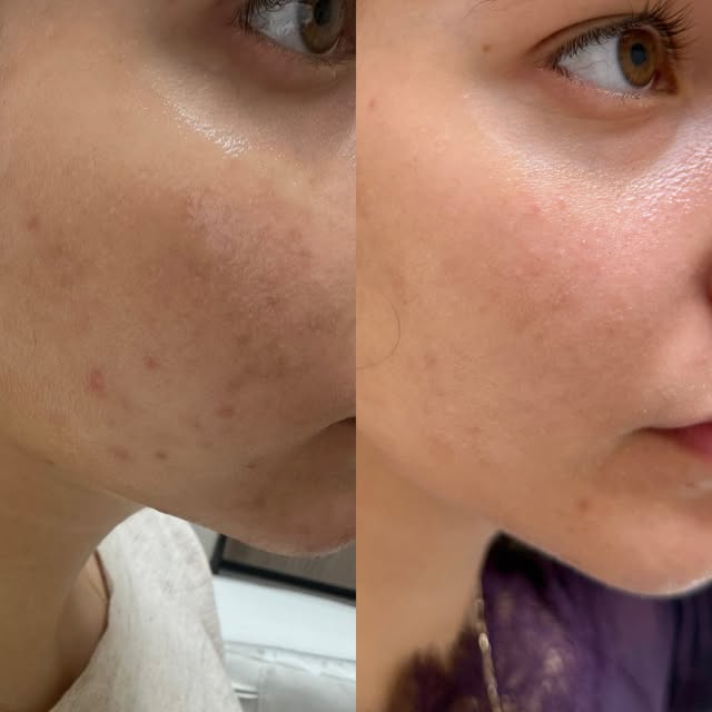 Real Patient. Real Results.

These two photos are 3 months apart.

Acne problems, Scars, Discolorati