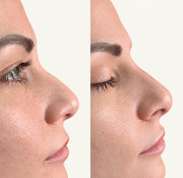 Rhinoplasty without the surgery?!

Little to no downtime?

This is the same day result?

Yes, this i