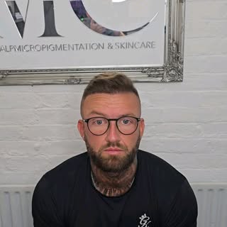 Fill in JOB after Hair Transplant and wanted to add more Density without the downtime and effort of 