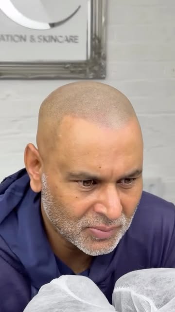 Natural scalp micropigmentation designed to replicate the appearance of real, freshly shaved hair fo
