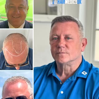 Stephen Sedgley, former professional footballer and two-time FA Cup winner, chose Hair Medics UK for