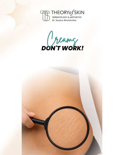 Stretch mark creams aren’t the whole answer. Here’s what actually works. 

Stretch marks are **derma