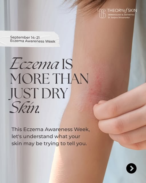 Eczema is more than dry or sensitive skin.

It is a chronic inflammatory condition that can affect c