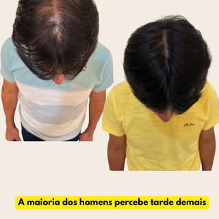 Grande parte dos homens só percebe a calvície quando o couro cabeludo começa a aparecer.

E o proble