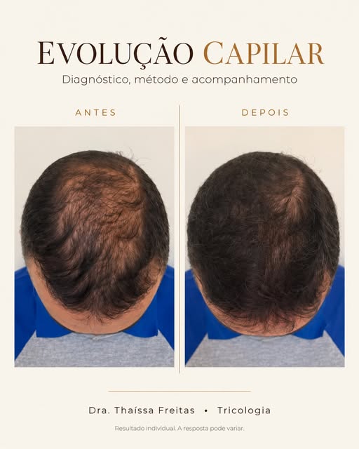 A alopecia androgenética é progressiva — e, sem tratamento, os fios tendem a se tornar cada vez mais