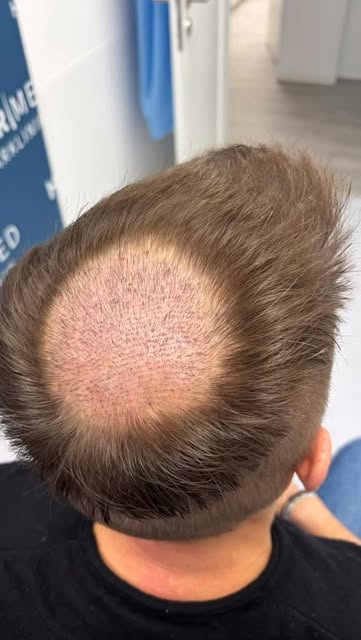 TONSUR / OBERKOPF

Der Tonsur-Bereich ist der sensibelste Bereich bei einer Haartransplantation.
Gle