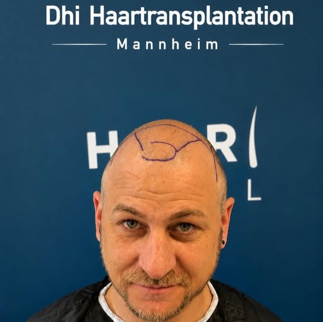 HAARMED – Haartransplantation in Mannheim. 

Qualität statt Masse: Nur 1–2 Patienten pro Tag für max