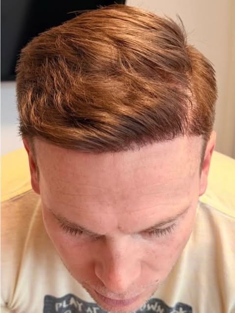 Haben Sie Haarausfall an der Tonsur, am Oberkopf oder an den Geheimratsecken – und stört Sie das?

W