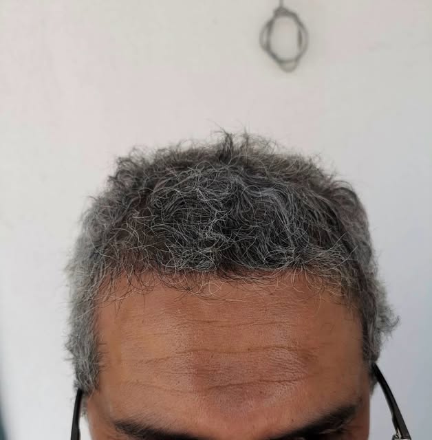 Für eine Haartransplantation müssen Sie nicht ins Ausland reisen oder unnötige Risiken eingehen. 🇩�
