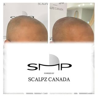 Hairline Restoration underway!! Looking forward to our final results!!
.
.
🚨 50 % OFF PROMO in effe