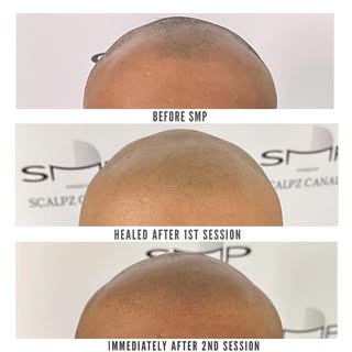 Trust in the process! 💯 Scalp Micro-pigmentation is a multi step process each session providing mor