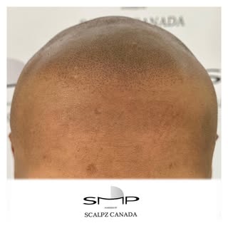 HAIRLINE RESTORED 🔥 

____________________________________________________

SCROLL THROUGH TO SEE T