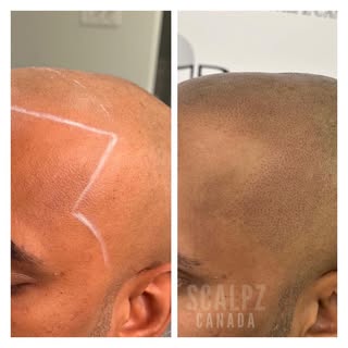 Hairline Restoration in Effect!! ⚡️

The Redness behind the impressions you’re seeing will diminish 