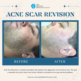Before & After: Acne Scar Revision ✔️

Performed by our licensed esthetician, Jessica, this male pat